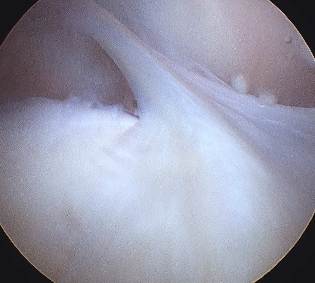 Medial Plica Arthrscopy Non Pathological